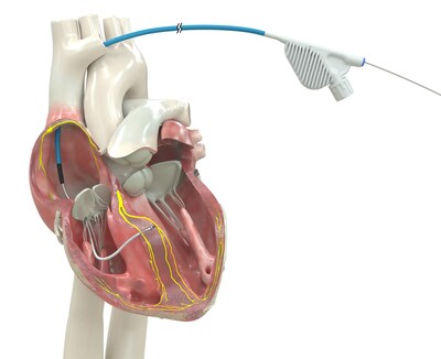 The OmniaSecure™ defibrillation lead is the first defibrillation lead approved by the FDA for placement in the left bundle branch area.